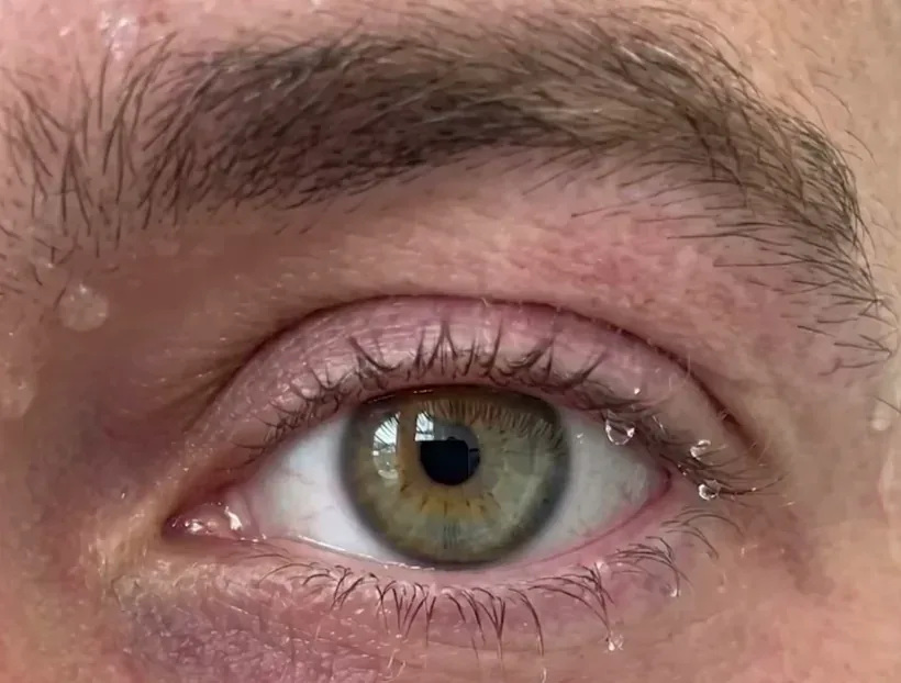 Close-up of red goggle marks around a swimmer’s eye