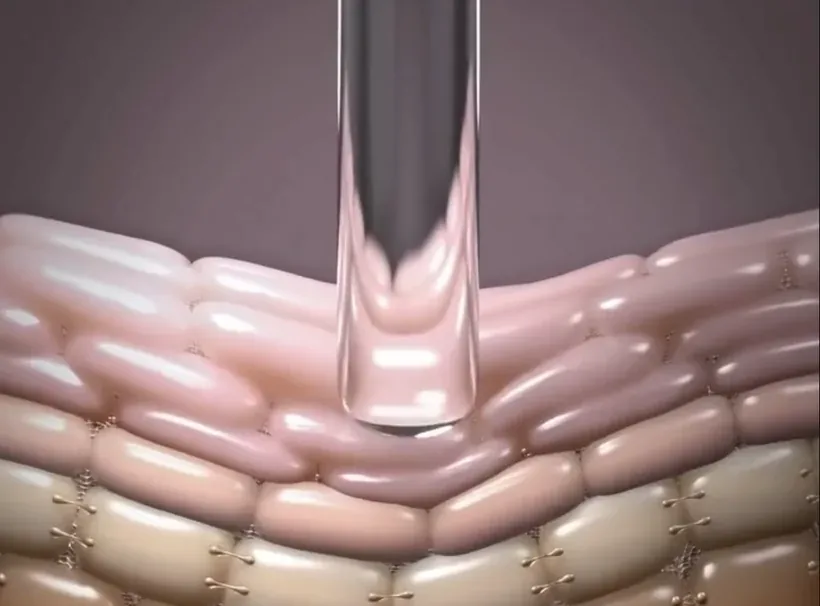 3D skin cross-section showing how tight goggle pressure compresses and bruises skin tissue